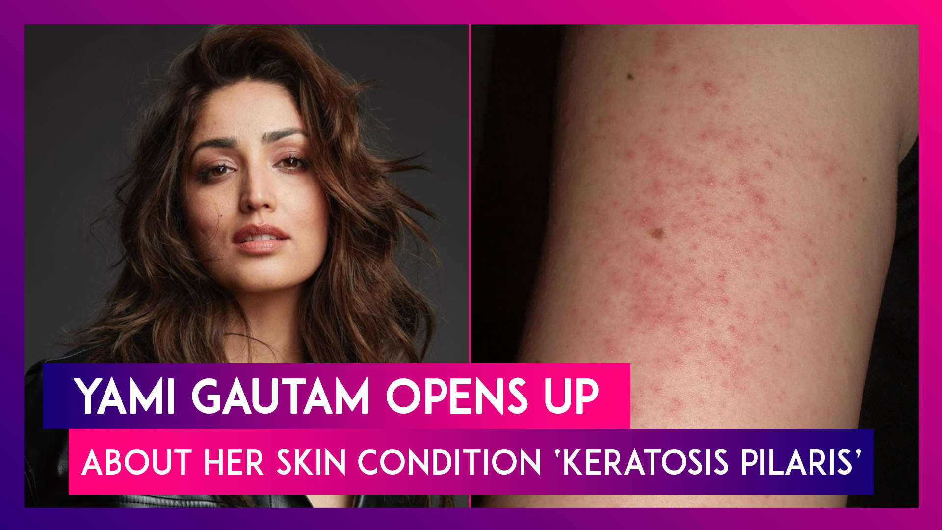 India : Yami Gautam Opens Up About Her Skin Condition Keratosis Pilaris ...