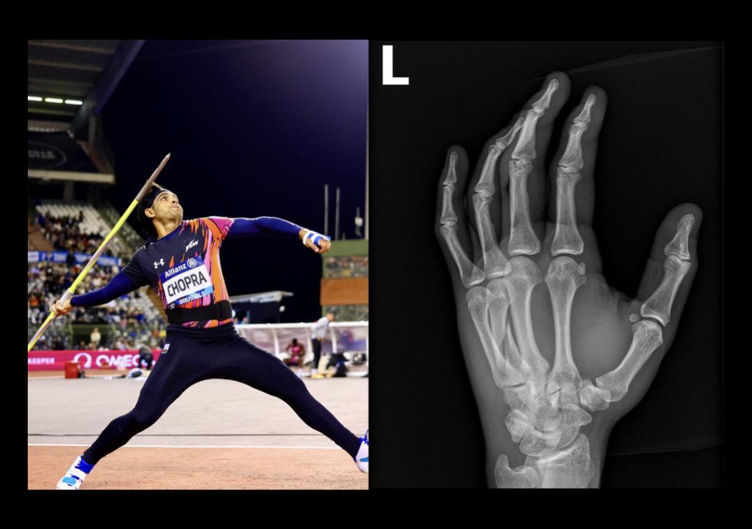 Neeraj Chopra reveals he played Diamond League final with fracture, shares pic of X-ray