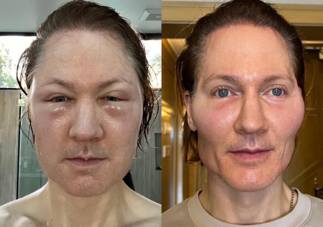 Millionaire Bryan says his face blew up after injecting donor's fat proteins, shares pic