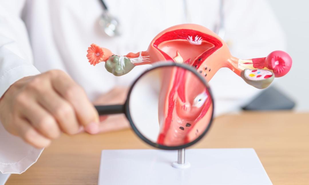 HPV vaccine highly effective in preventing cervical cancer: Study