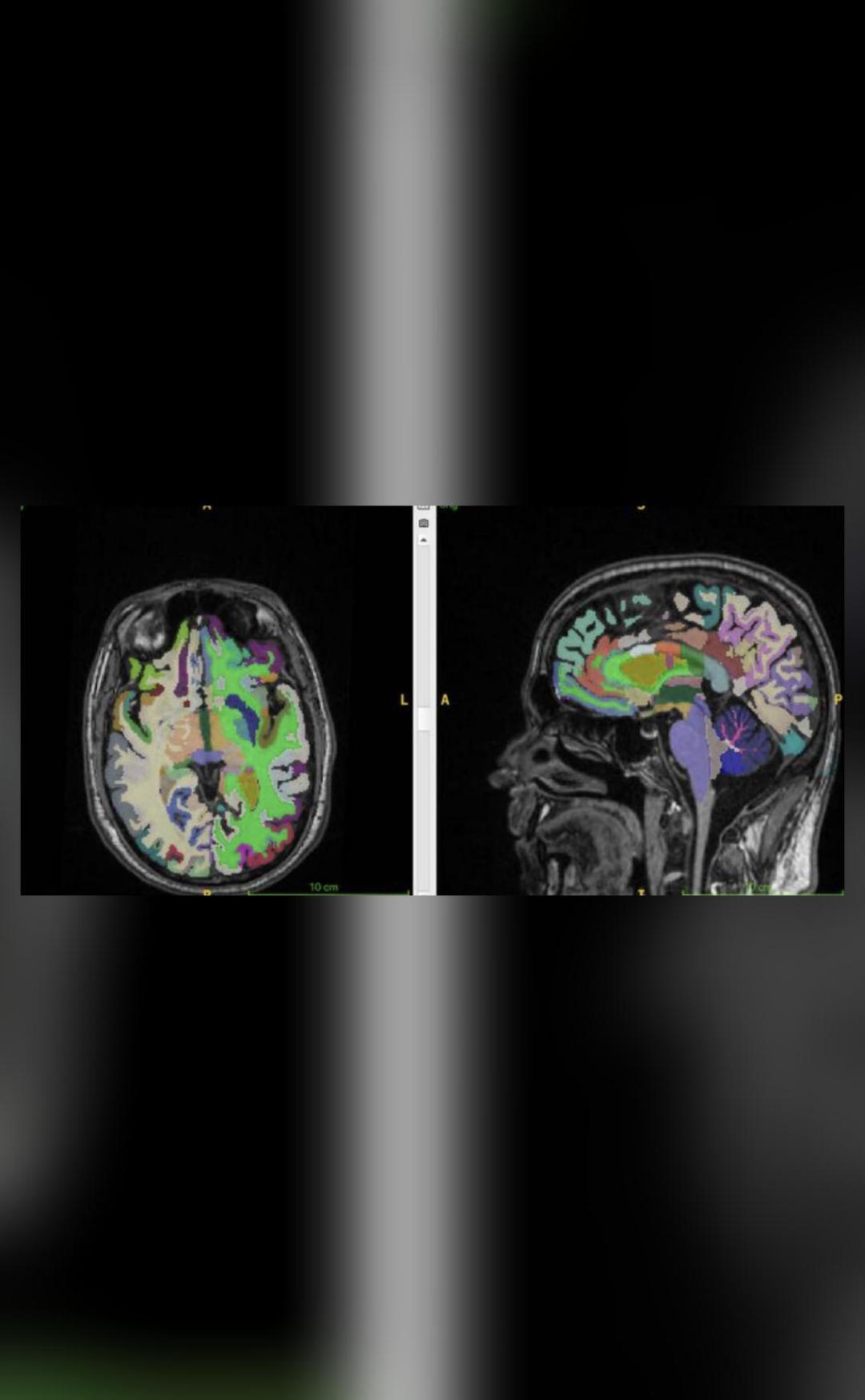 High muscle mass, low visceral fat linked to younger brain age