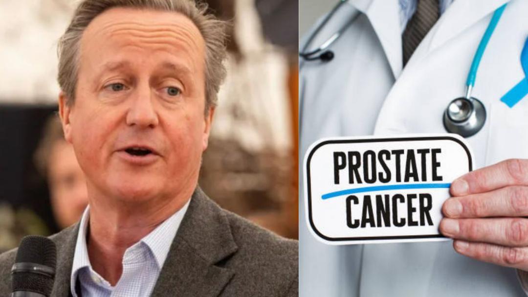 David Cameron chose focal therapy for prostate cancer treatment