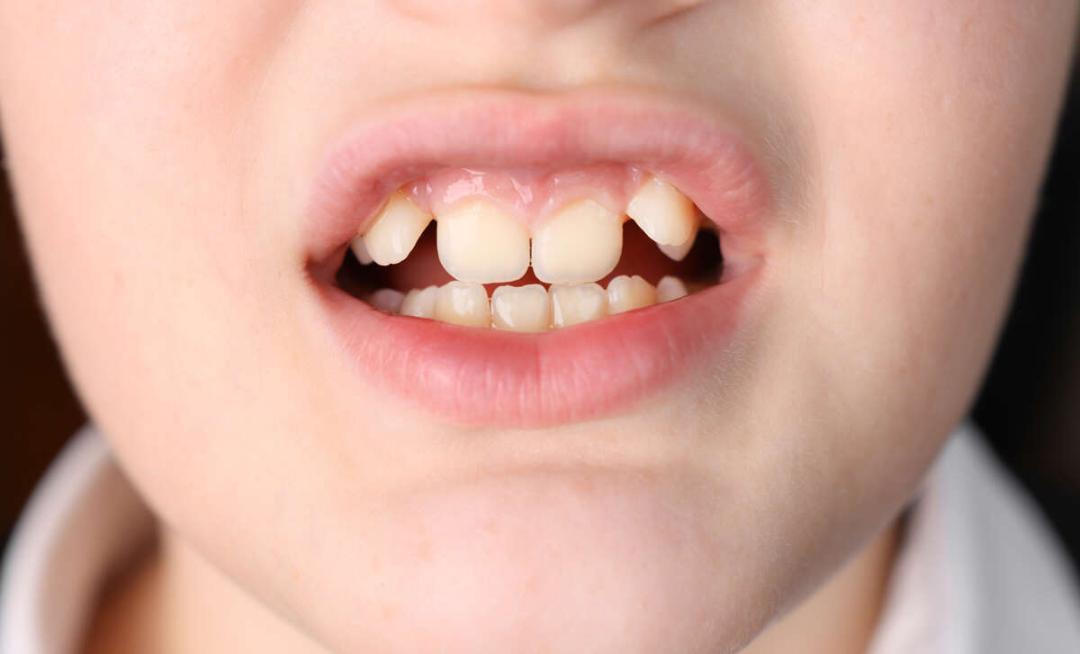 Expert reveals why early decay and cavities in milk teeth matter
