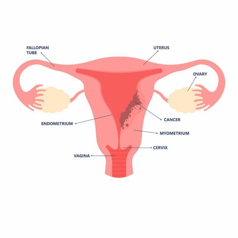 Expert explains how weight cycling raises endometrial cancer risk