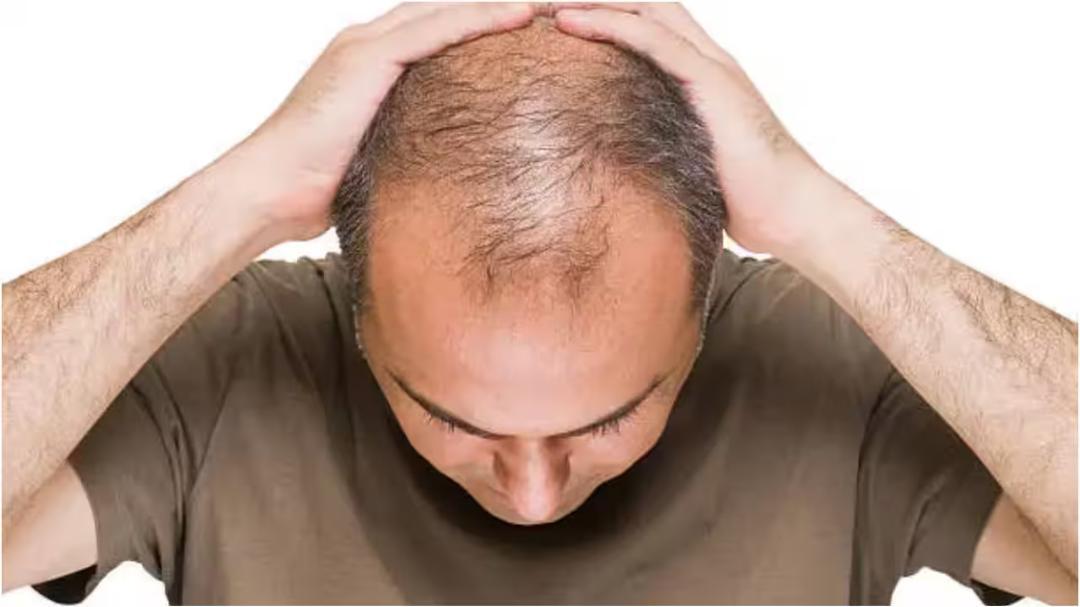 Single stressful event enough to trigger recurring hair loss: Study