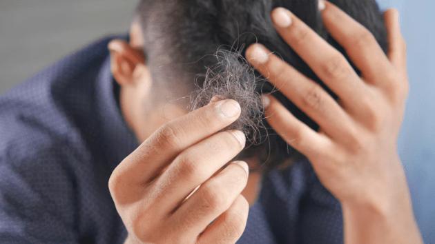 How can sugar intake lead to hair loss?
