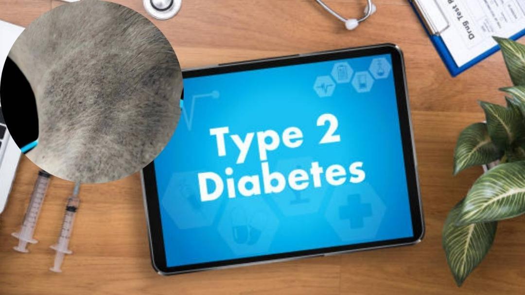 Doctor reveals 5 lesser-known diabetes symptoms 