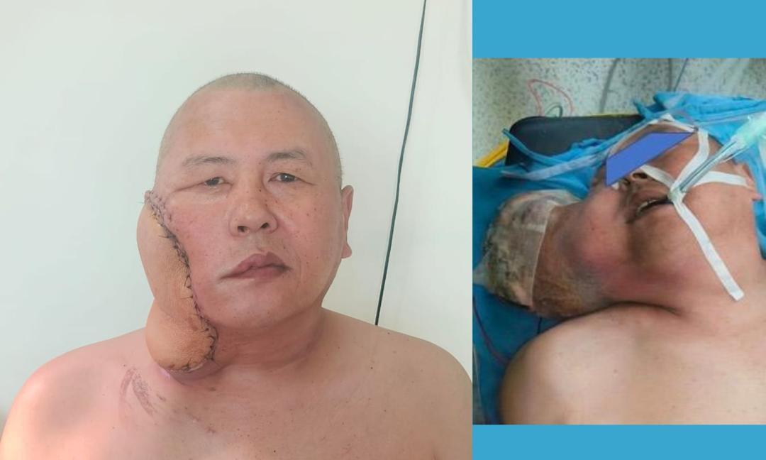 Delhi hospital removes rare 4.5 kg tumour after 10-hour surgery