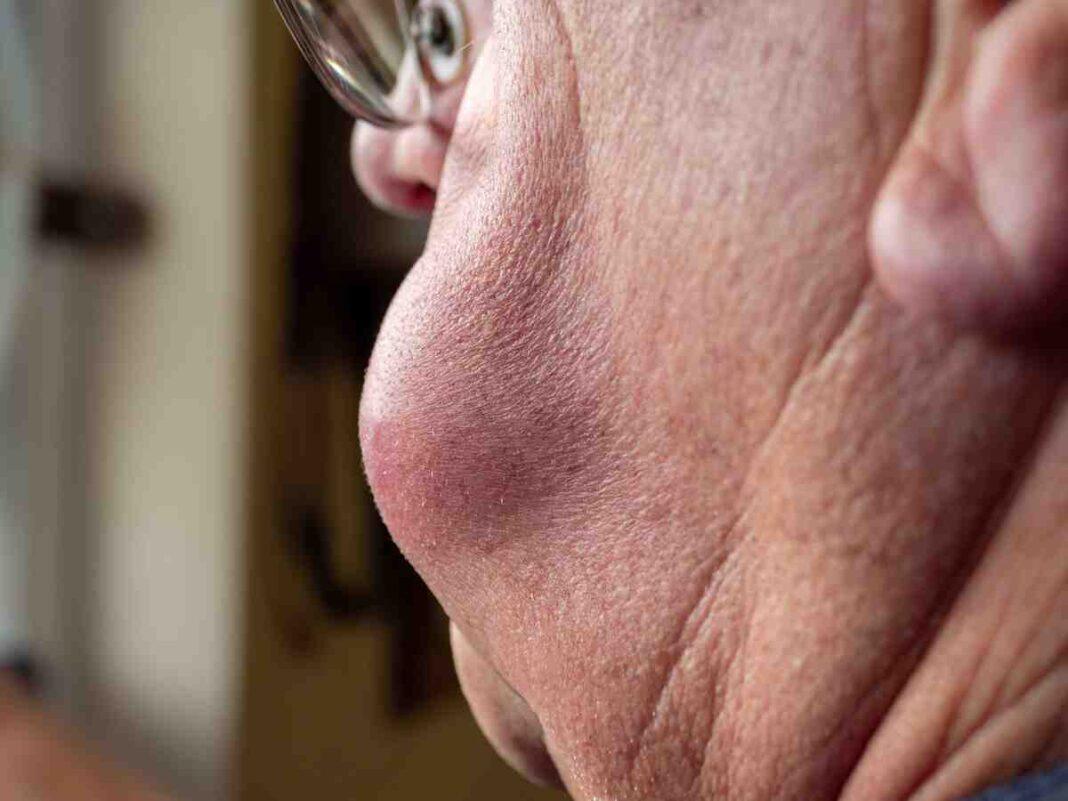 Can GathHeal cure lipoma? 