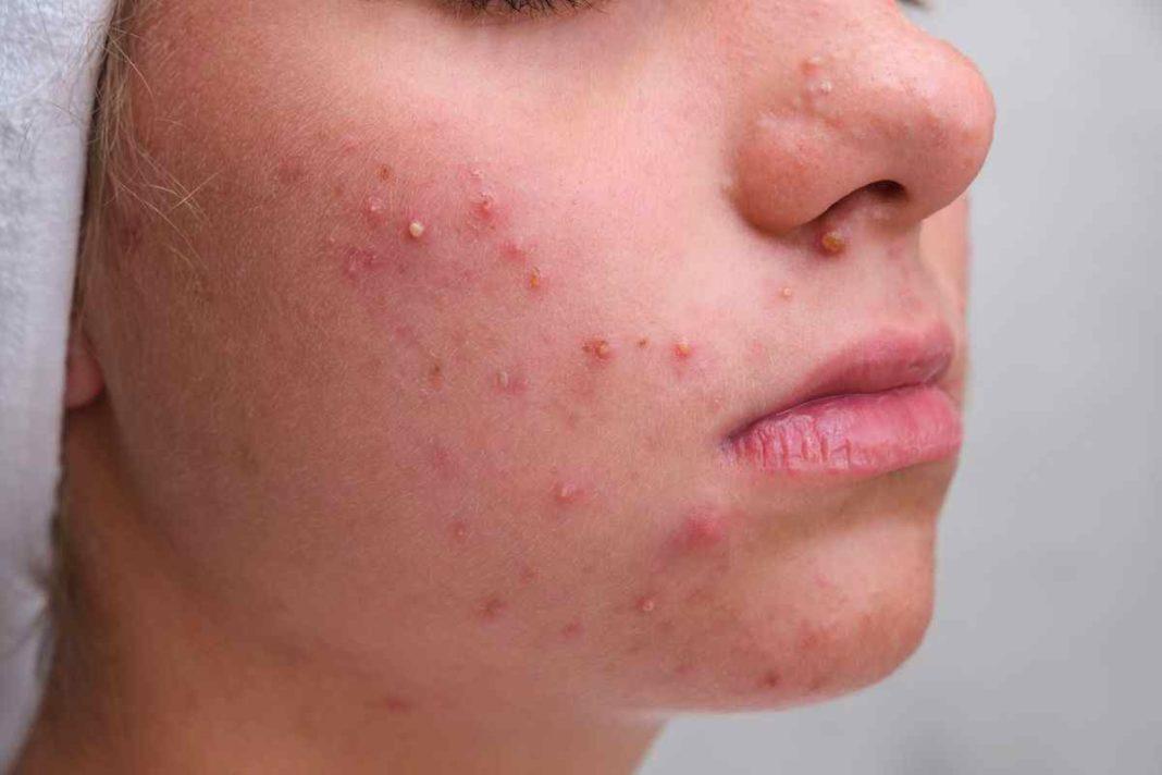 Can a Salicylic Acid face mist prevent acne? The real story