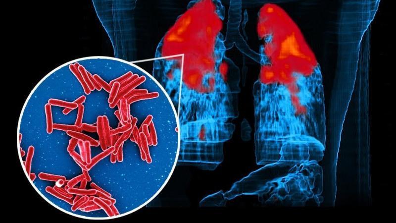 IIT Bombay finds how tuberculosis bacteria resist treatment