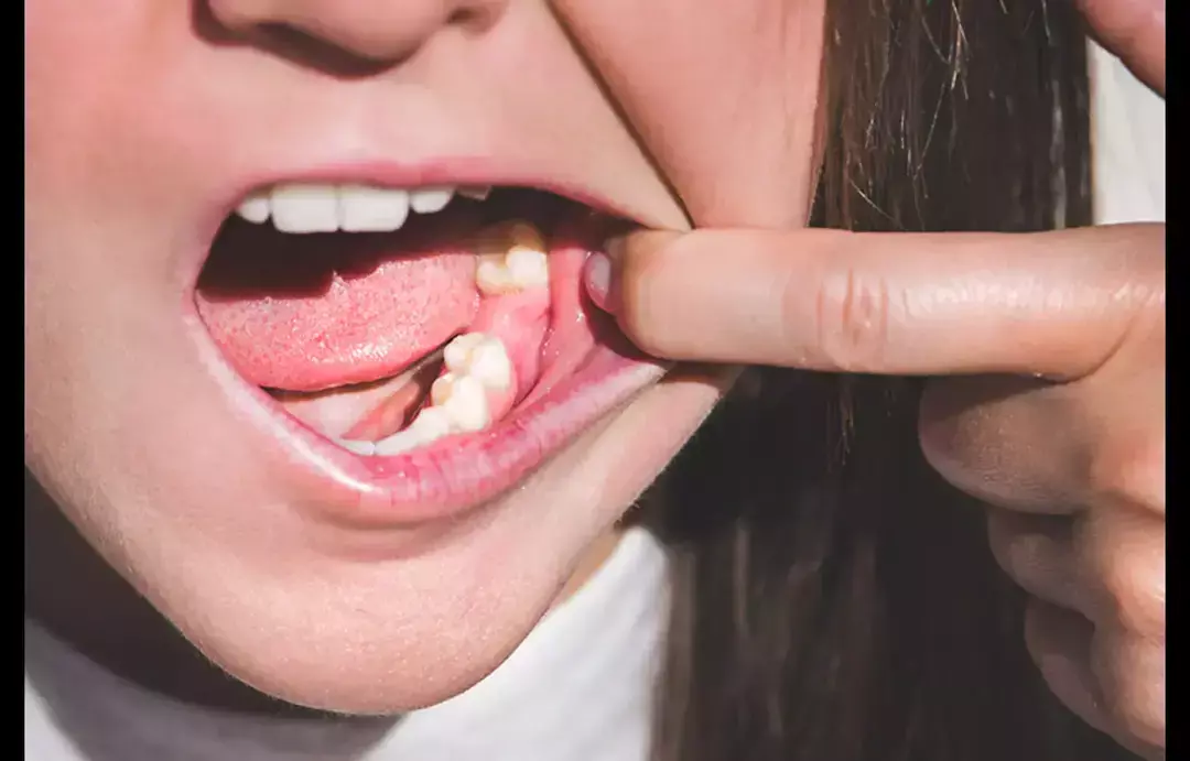 Tooth loss tied to cardiovascular, respiratory deaths: Study