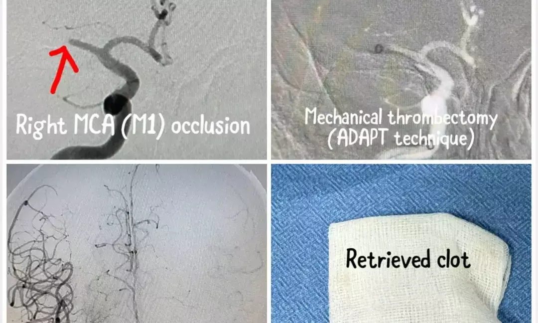 9-minute stroke rescue rapid procedure saves patient in Vizag